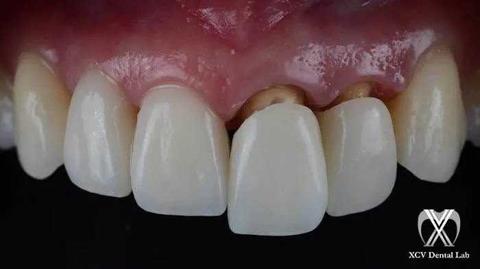 Zirconia vs. E.max: Material-Specific Prep Guidelines