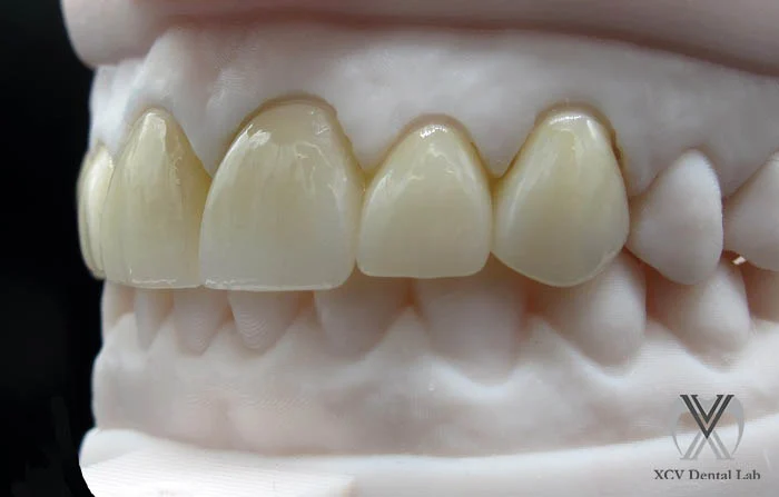 Close-up of Cercon® ht ML full-contour crown with lifelike colour transition