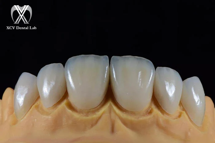 High Translucent Multilayer Zirconia restoration offering natural translucency and aesthetics
