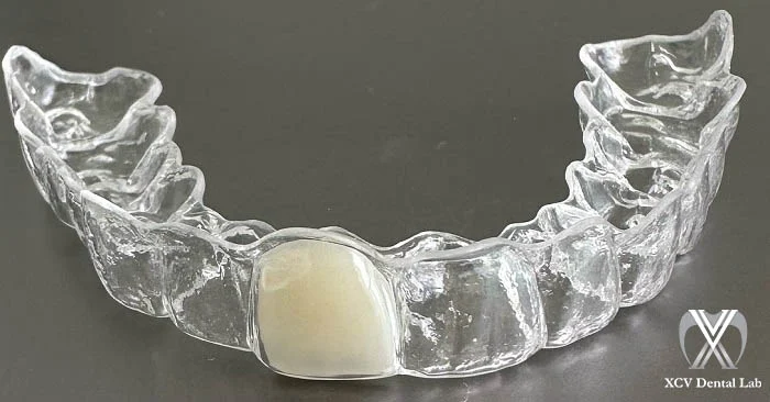 Clear orthodontic Essix retainer made from thermoplastic material, shown fitted over upper teeth