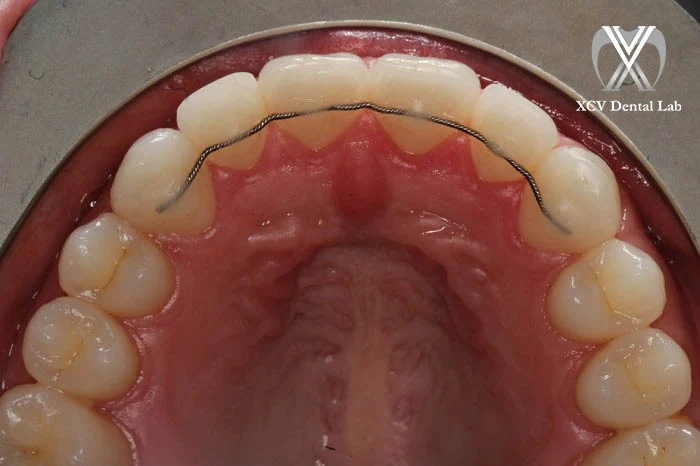 Fixed orthodontic retainer bonded behind lower front teeth using a thin wire for permanent retention